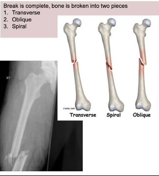 <p>Break is complete, bone is broken into 2 pieces</p><ol><li><p>Transverse</p></li><li><p>Oblique</p></li><li><p>Spiral</p></li></ol><p></p>