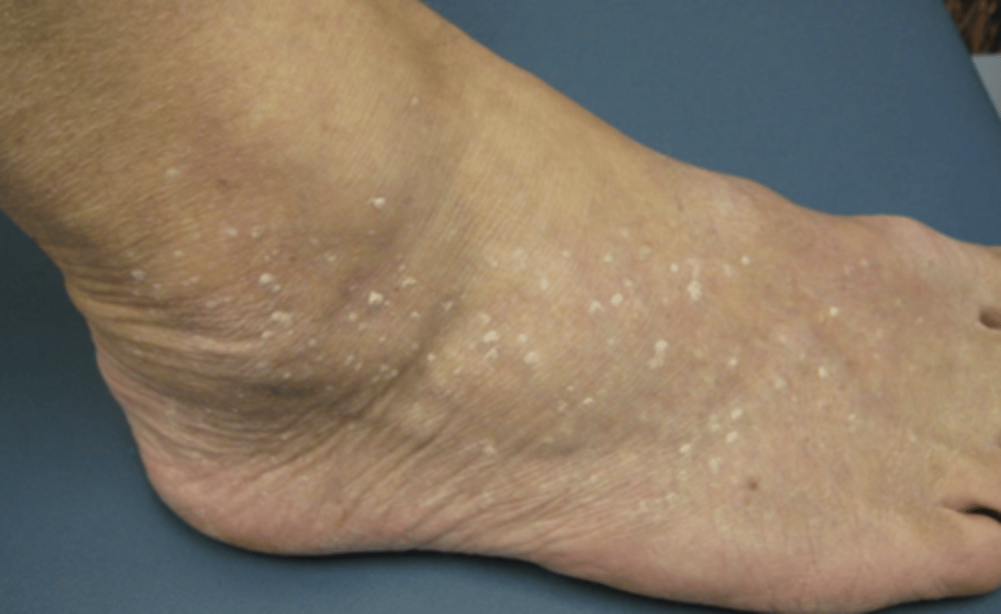<p>small white-gray SKs on dorsal feet/ankles of older light-skinned individuals.</p>