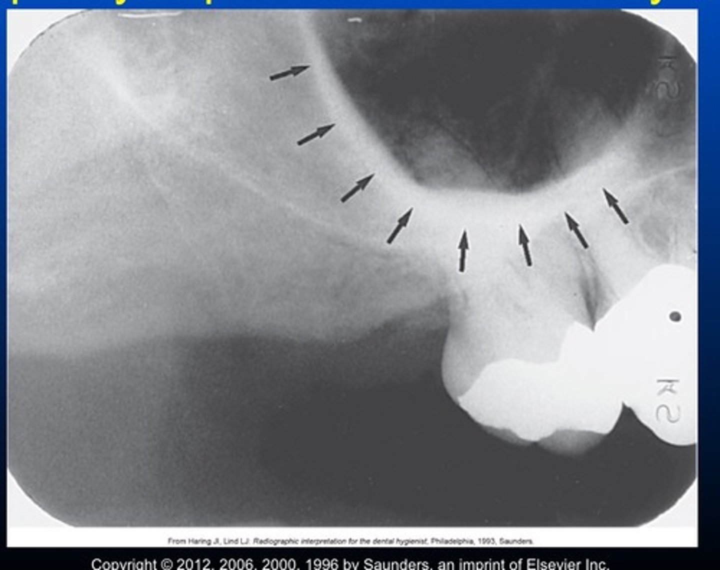 <p>They ask about the radiopaque seen above the molar teeth</p>