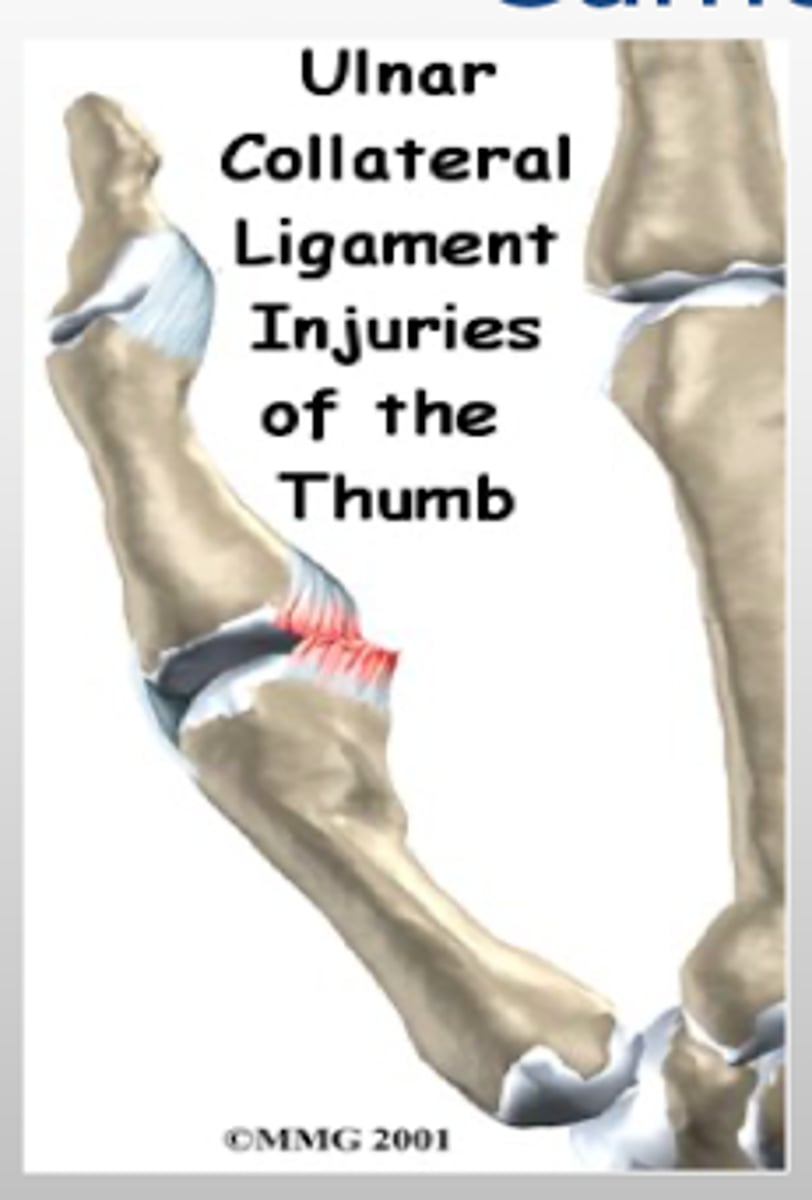 <p>injury to the ulnar collateral ligament (UCL) of the thumb with or without avulsion</p><p>Occurs due to forced abduction or hyperextension of the proximal phalanx of the thumb</p>