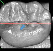 <p>crreate 3D image nased on NIR light reflection to visualize internal tooth structure and identify carious lesions with high precision</p>