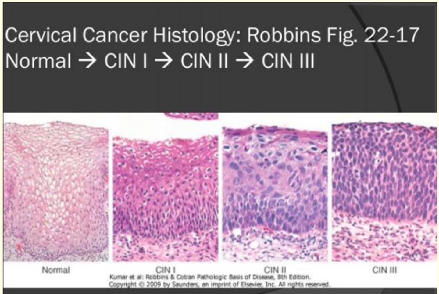 <p>Cervical Intraepithelial neoplasia</p>