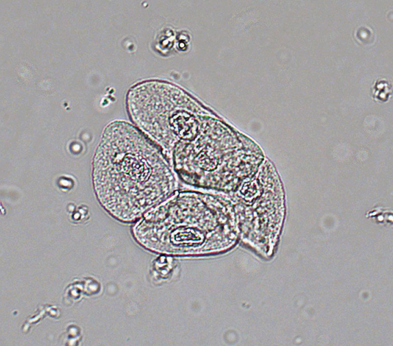 <p>Smaller than squamous cells and have centrally located nucleus; water absorbability</p><ul><li><p>Originates from lining of:</p><ul><li><p>Both: renal pelvis, calyces, ureters, and bladder</p></li><li><p>Male: upper urethra</p></li></ul></li></ul><p></p>