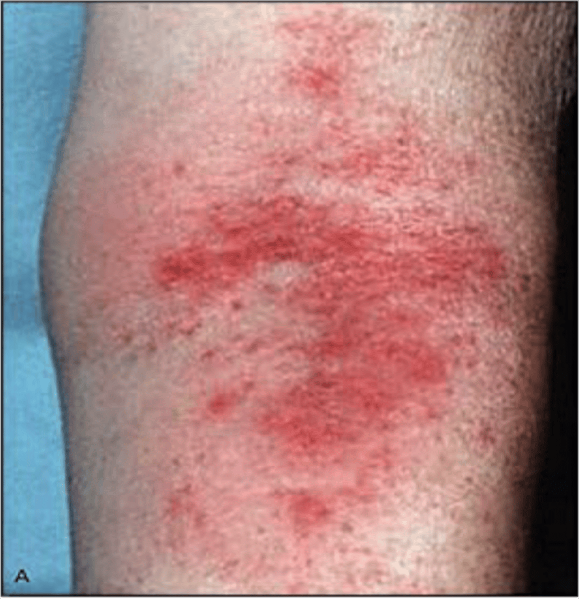 <p>Pruritus PLUS ≥3 of: onset <2 years, flexural involvement, dry skin, personal/family atopy, visible eczema</p>