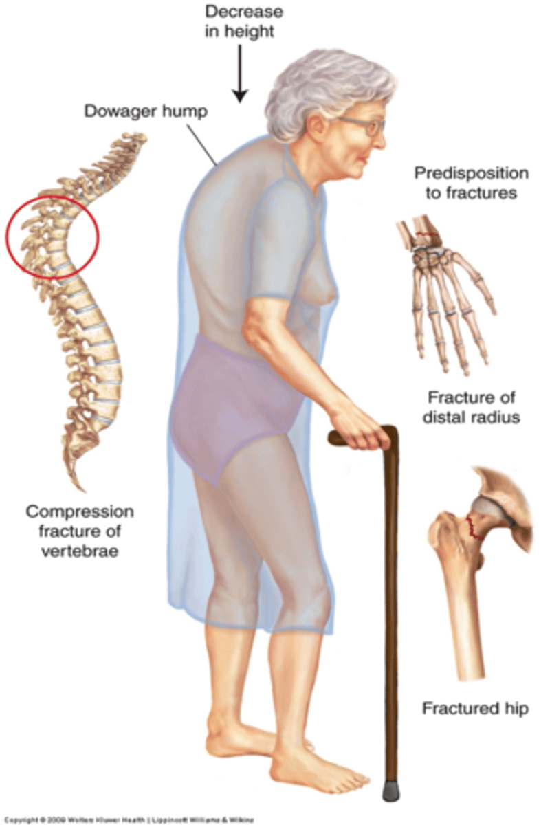 <p>-Excessive curvature of the thoracic spine.</p><p>-Typically the result of vertebral body factures caused by osteoporosis.</p>