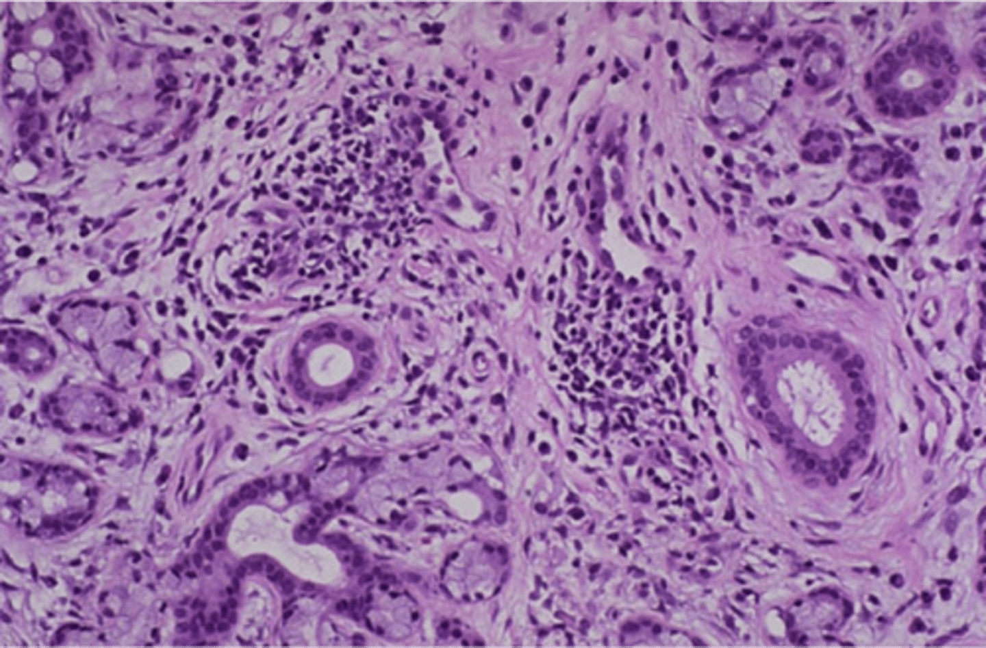 <p>Sjogren syndrome</p><p>(autoimmune destruction of exocrine glands)</p><p>Can have RF, Anti-SSA or SSB</p><p>Lymphocytic sialadenitis</p><p>Risk of B-cell lymphoma</p>