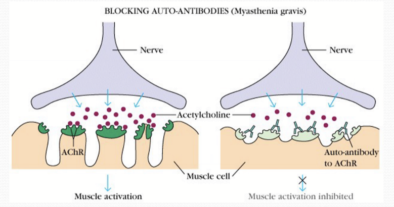 <p>Impaired NMJ commonly due to presence of antibodies binding to AChR of muscle cells in synaptic cleft, block ACh, and prevent receiving muscle cell from propagating signal</p>