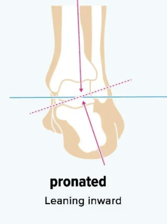 <p><strong>Impairment:</strong></p><ul><li><p><span style="color: blue;">Hindfoot valgus deformity</span></p></li><li><p><span style="color: blue;">foot invertor weakness (Tibialis Ant + Post)</span><br></p></li></ul><p><strong>Deviation/Compensation:</strong> <span style="color: red;"><strong>Excessive pronation</strong></span></p><p></p>