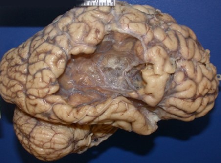 what type of necrosis is this?
