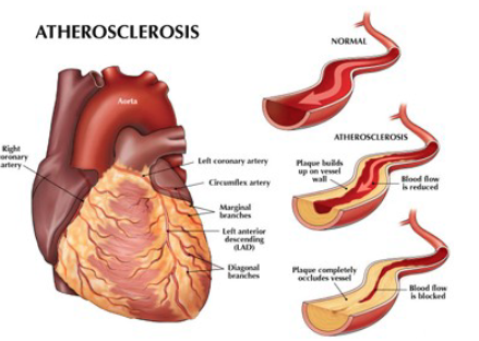 <p>condition where a blood vessel hardens because of the layer of fat accumulated inside it</p>