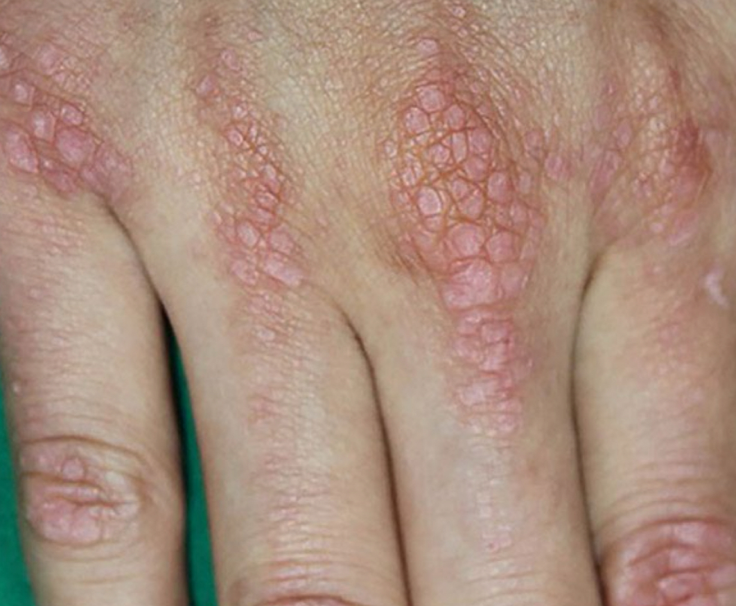 <p>what type of lesion and condition is depicted</p>