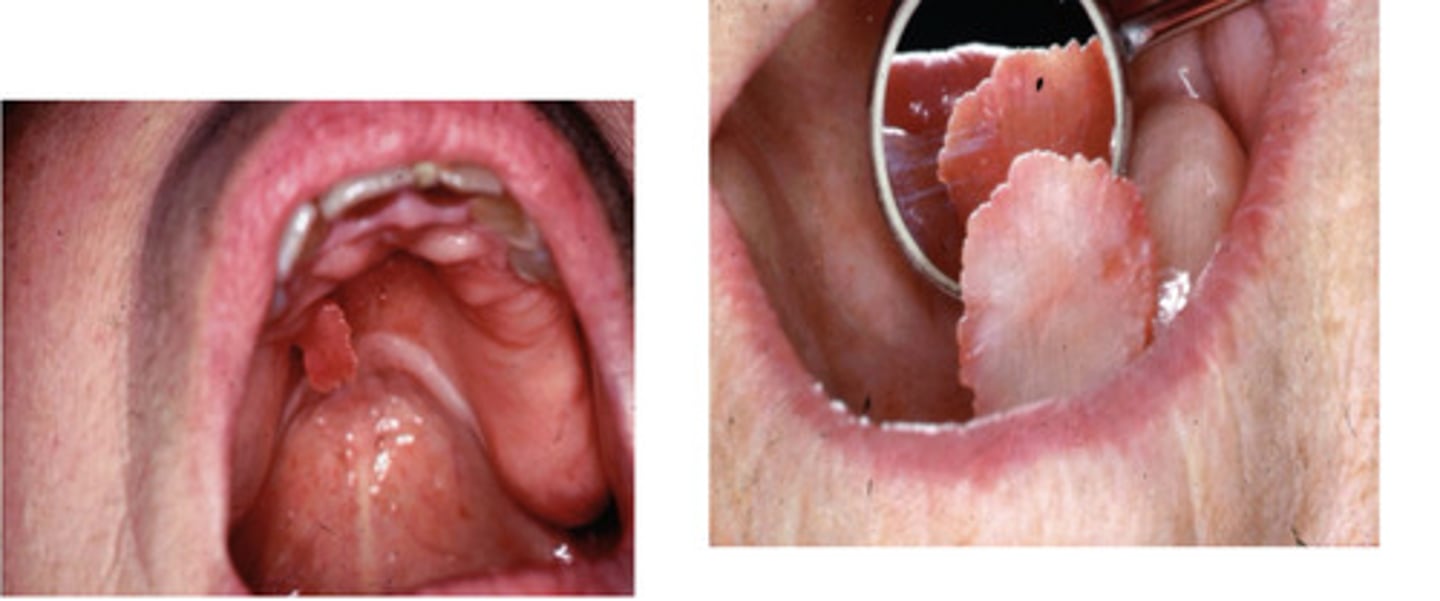 <p>Flattened pedunculated mass on maxilla from denture</p>