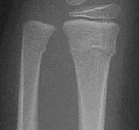<p>Which fracture is this?</p>
