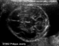 <ol><li><p>What is abnormal about this image?</p></li><li><p>This finding can be associated with what pathologies?</p></li></ol><p></p>