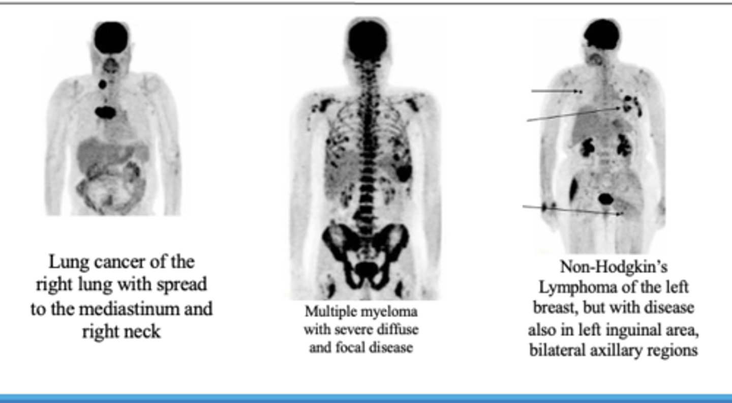 <p>•PET scan measures important body functions, such as blood flow, oxygen use, and glucose metabolism</p><p>•PET can be used to evaluate tumors and cancers, myocardial functioning and brain functioning.</p>