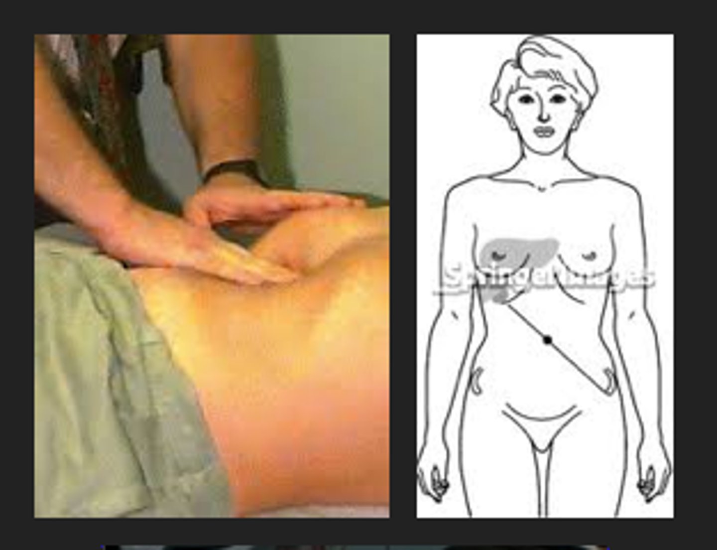 <p>Pain /c inhalation when fingers hooked under R ribs; indicative of cholecystitis.</p>