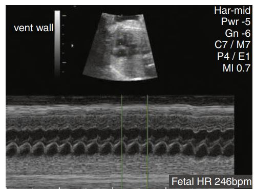 <p>Tachycardia was identified in this patient with a heart rate of 246 beats/min.</p><p> ___________ caused by cardiac insufficiency is one of the most common causes. Cardiac insufficiency can result from cardiac anomalies or arrhythmias .</p>