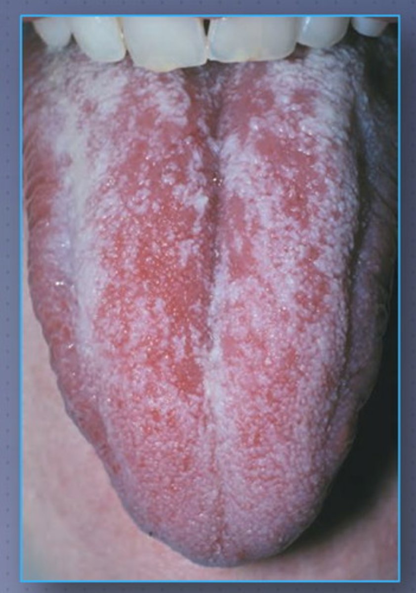<p>PAINFUL; Antibiotic Sore Mouth</p><p>• red, shiny patches</p><p>• common location: usually on tongue</p><p>• usually surrounded by white flecks </p>