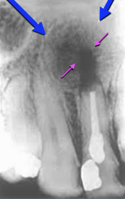 <p><strong>Healing Cyst</strong></p>