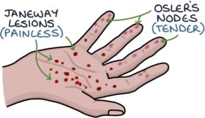 <p>S. Aureus, S. Pyogenes</p><p>Vegetation of the endocardium- clusters of bacterial cells, platelets, and fibrin</p><p>Flu-like symp, arrhythmias, myalgia, arthralgia, abcesses around valves</p><p>OSLERS NODES- painful, erythematous nodules on finger and toes</p><p>JANEWAY LESIONS- painless, erthematous patches on palms and soles</p><p>Break loose and travel to brain/lungs/kidneys</p><p>(human)</p><p>cant be trasmitted person to person</p><p>Entry of bacteria into bloodstream when burshing teeth, dental procedures or drug use</p><p></p>