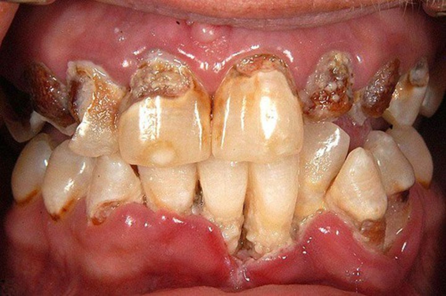 <p>-"Trench Mouth"</p><p>-Destruction of periodontium</p><p>-Associated with poor dental hygiene, emotional stress, tobacco use, IC state</p><p>-Caused by <strong>Fusobacterium &amp; Spirochetes</strong></p><p>-Pt presentation: Fever, malaise, lymphadenopathy; foul breath;<strong> metallic taste</strong></p><p>-CX: Painful, edematous papillae; Ulcers with overlying pseudomembrane; gingiva is inflamed, friable, and necrotic</p>