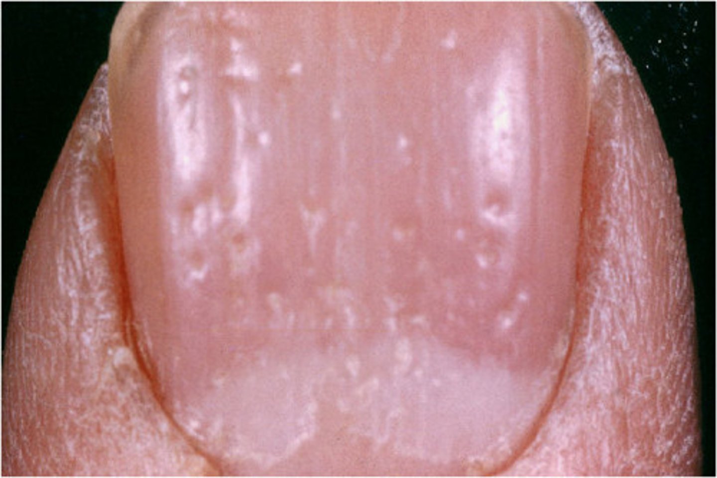 <p>depressions of nail plate caused by a defective proximal nail matrix</p>
