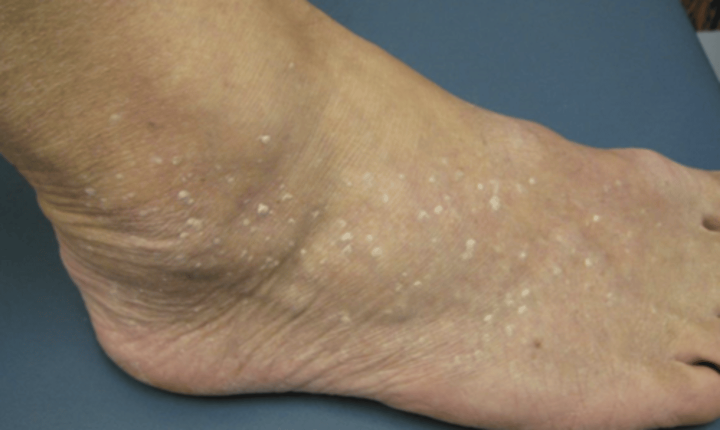 <p>What is the treatment for stucco keratoses?</p>