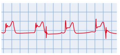 <p>blood supply to part of heart muscle is blocked trough and peaks become less distinct and not as regular, S-T portion of ECG is higher (S-T elevation)</p>