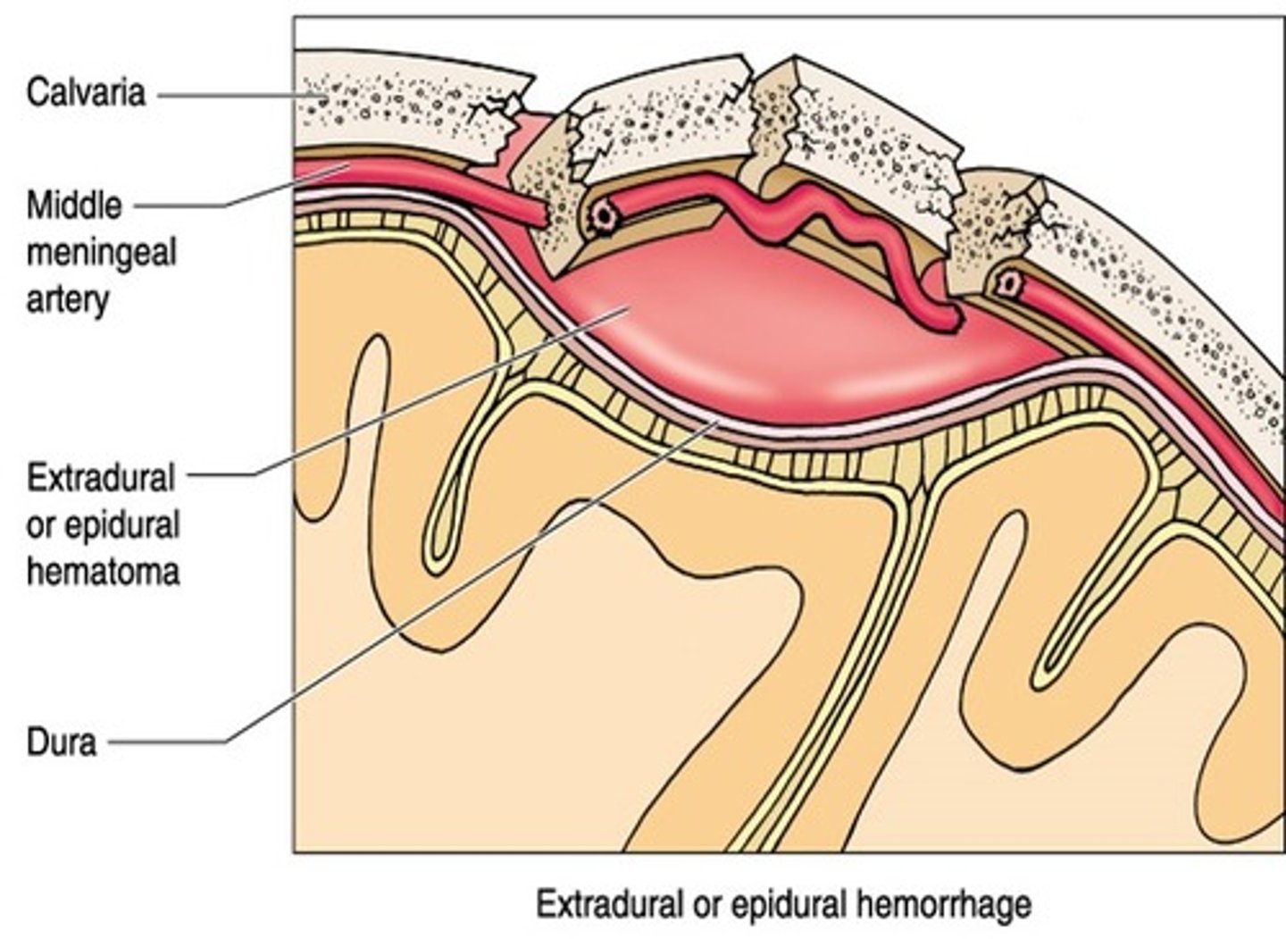 <p>epidural haemorrage</p><p>younger population - dura becomes more fused to skull as you get older</p><p>can be a torn venous sinus but mostly from middle meningeal artery</p><p>* bleeding cant cross a suture line</p>
