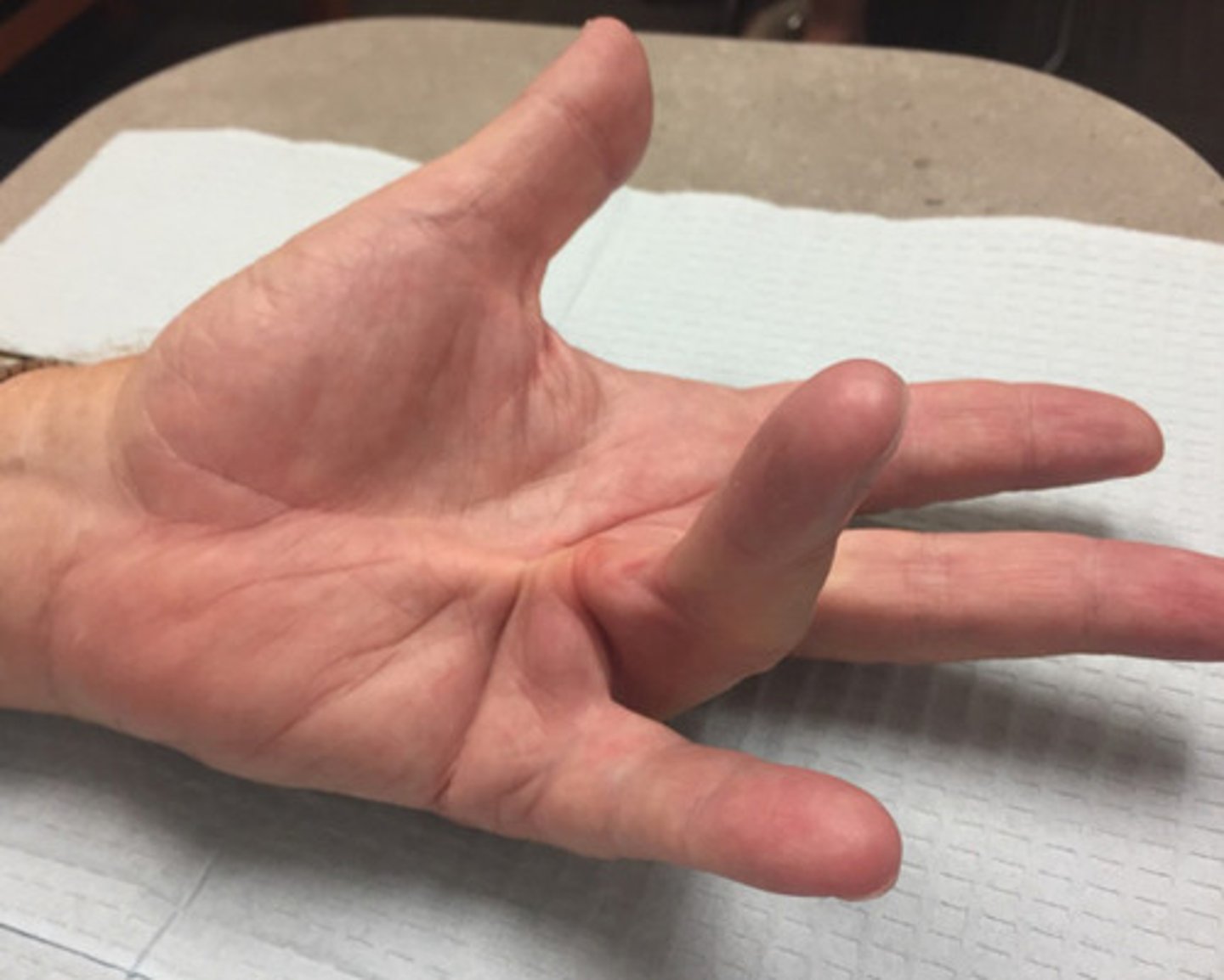 <p>- mn. tenyérzsugor/ tenyéri bőnye zsugorodása</p><p>- kromoszómálisan, recesszíven öröklődik</p><p>- jellemzően a gyűrűs ujjnál ( kis, középső ujjnál) alakul ki</p>