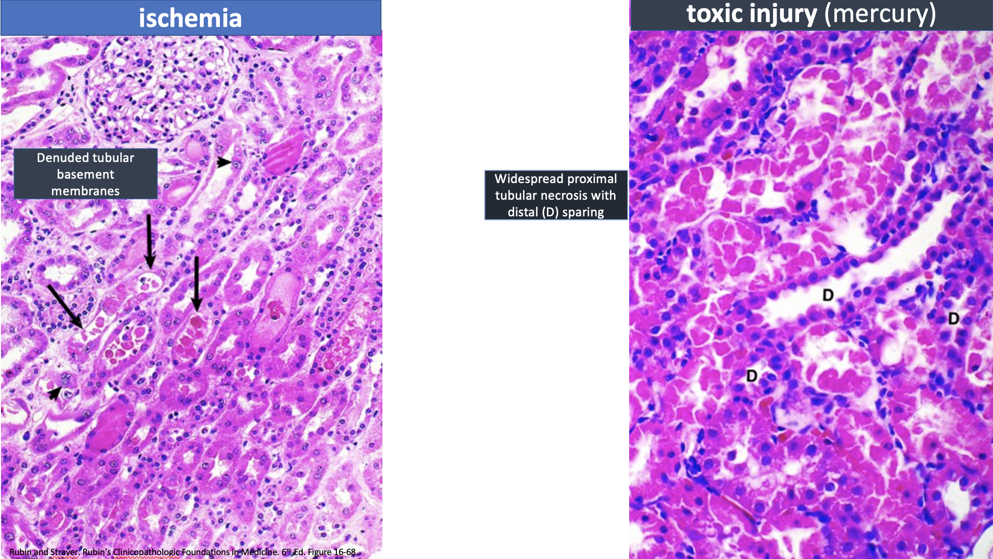 <p>What do these 2 etiologies cause?</p>