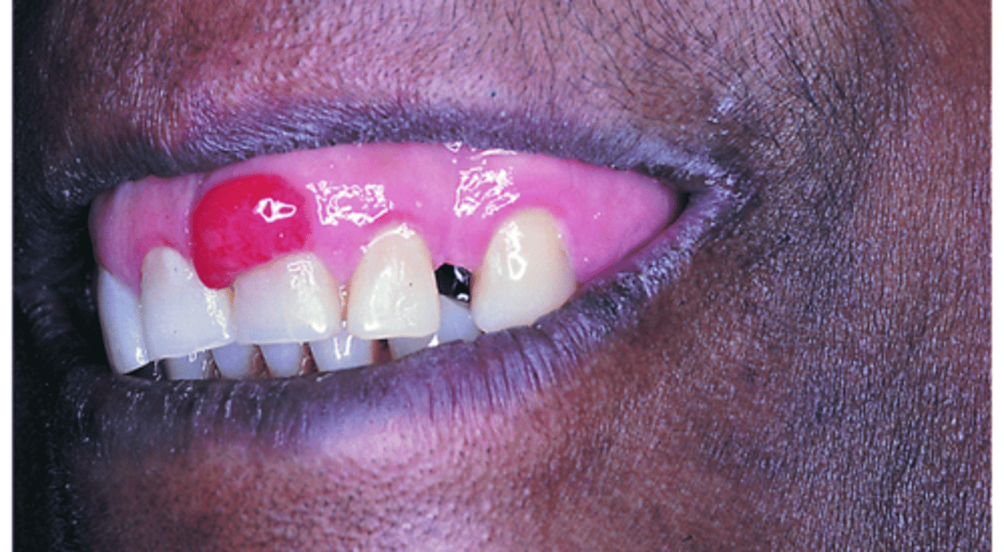 <p>Most commonly observed on the gingiva; Most common in teenagers & young adults; If seen in pregnant female, it is called a pregnancy tumor; May be caused by hormonal changes & increased response to plaque</p>