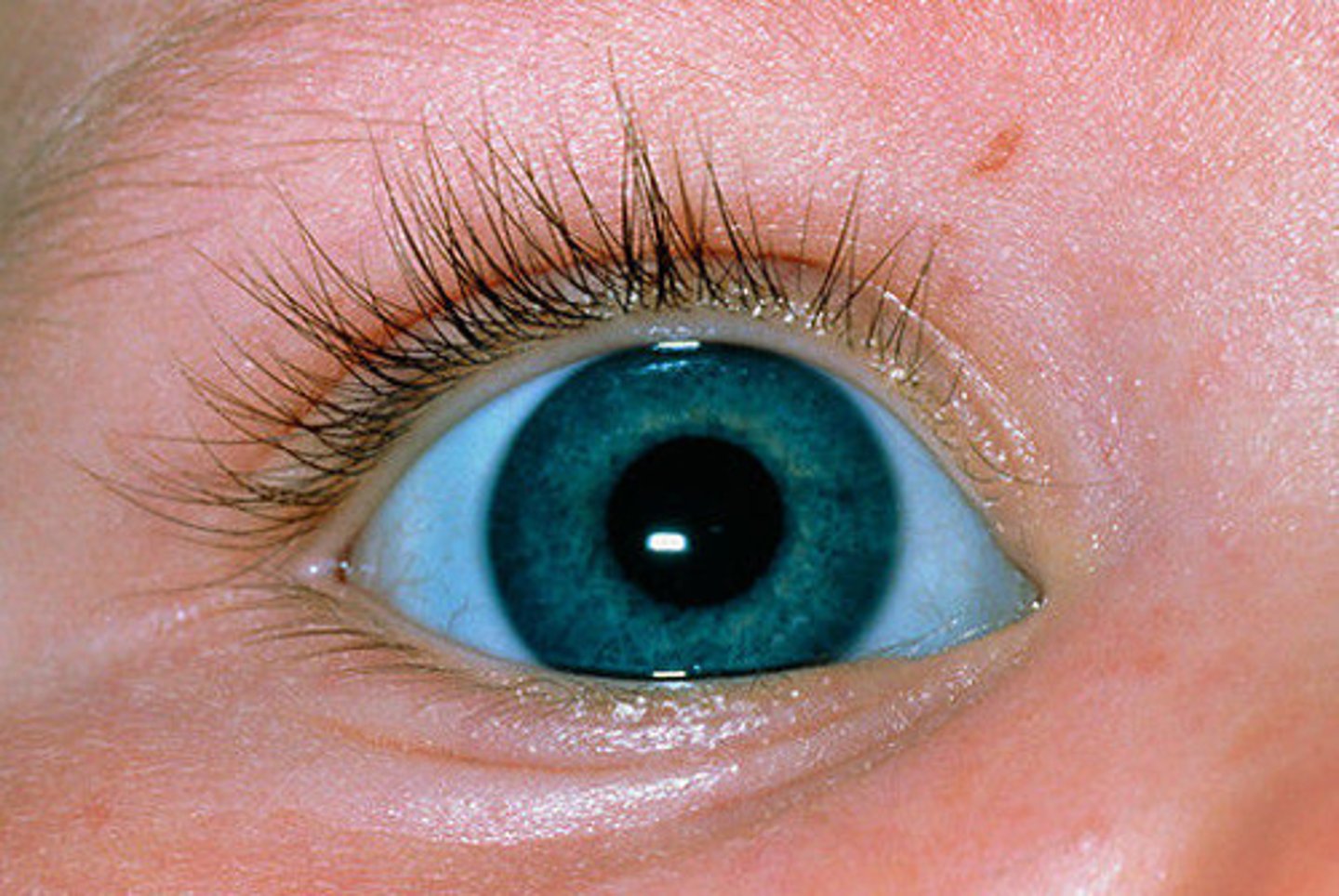 <p>Osteogenesis Imperfecta (Type I collagen defect forming triple helix)</p><p>Blue due to exposure of choroidal veins</p>
