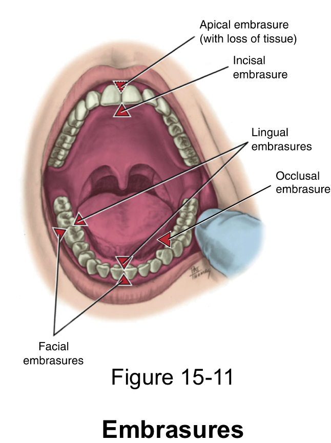 <p>spaces that are formed next to the contact area when two teeth in the same arch contact</p>