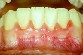 <p>cavity</p><p>different areas/may be in one area</p><p>inflamed gum<br>-red+swollen margins<br>-red+swollen+blunted papillae</p><p>E: brushing teeth<br>teens<br>young adults<br>pregnancy</p>