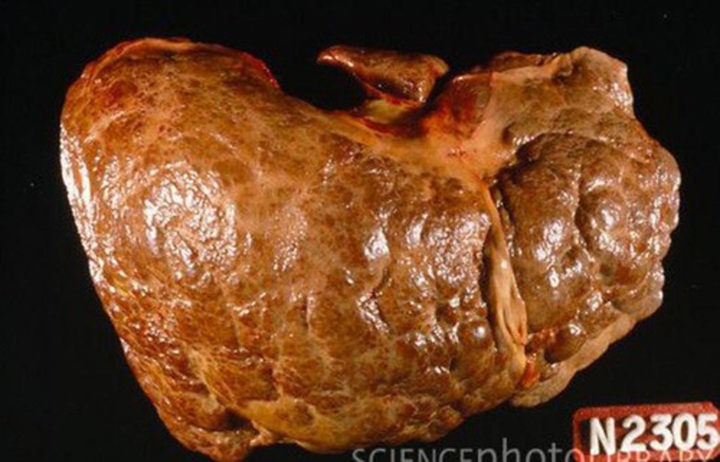 <p>Chronic "late-stage" liver disease due to ongoing hepatocellular injury &amp; inflammation leading to fibrosis, scarring/distortion of hepatic architecture, &amp; nodule formation</p>