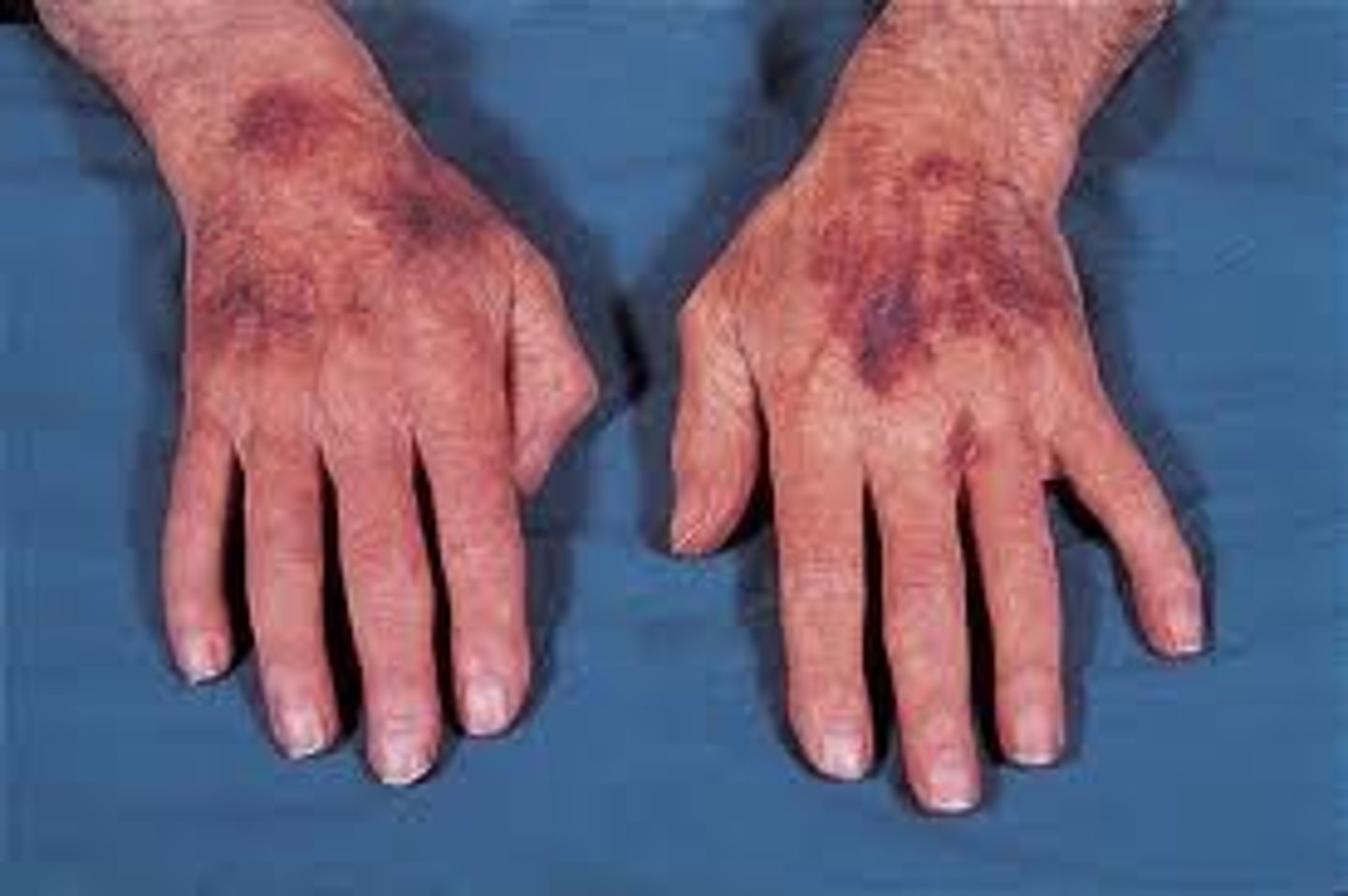 <p>hemorrhagic disease that produces ecchymosis and petechia, usually at multiple sites</p>
