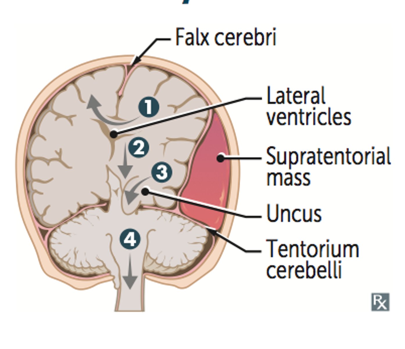 <p>the cerebellum herniates downward, pushing caudal portions of the brainstem through the foramen magnum. This has a high chance of compressing the medulla. (4)</p>