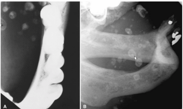 <p>likely diagnosis of these “bulls-eye" lesions</p>