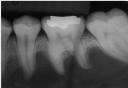 <p>A radiolucent lesion that extends between the roots, as seen in a traumatic bone cyst (TBC)</p>