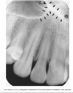 <p><span><span>·</span></span><span style="font-family: "Times New Roman"; line-height: normal; font-size: 7pt;"><span> </span></span><span><span>The intersection of the maxillary sinus and the nasal cavity</span></span></p><p class="MsoListParagraphCxSpMiddle"><span><span>·</span></span><span style="font-family: "Times New Roman"; line-height: normal; font-size: 7pt;"><span> </span></span><span><span>A radiopaque upside-down Y formed by the intersection of the lateral walls of the nasal fossa and the anterior border of the maxillary sinus</span></span></p><p class="MsoListParagraphCxSpLast"><span><span>·</span></span><span style="font-family: "Times New Roman"; line-height: normal; font-size: 7pt;"><span> </span></span><span><span>Above maxillary canine</span></span></p>