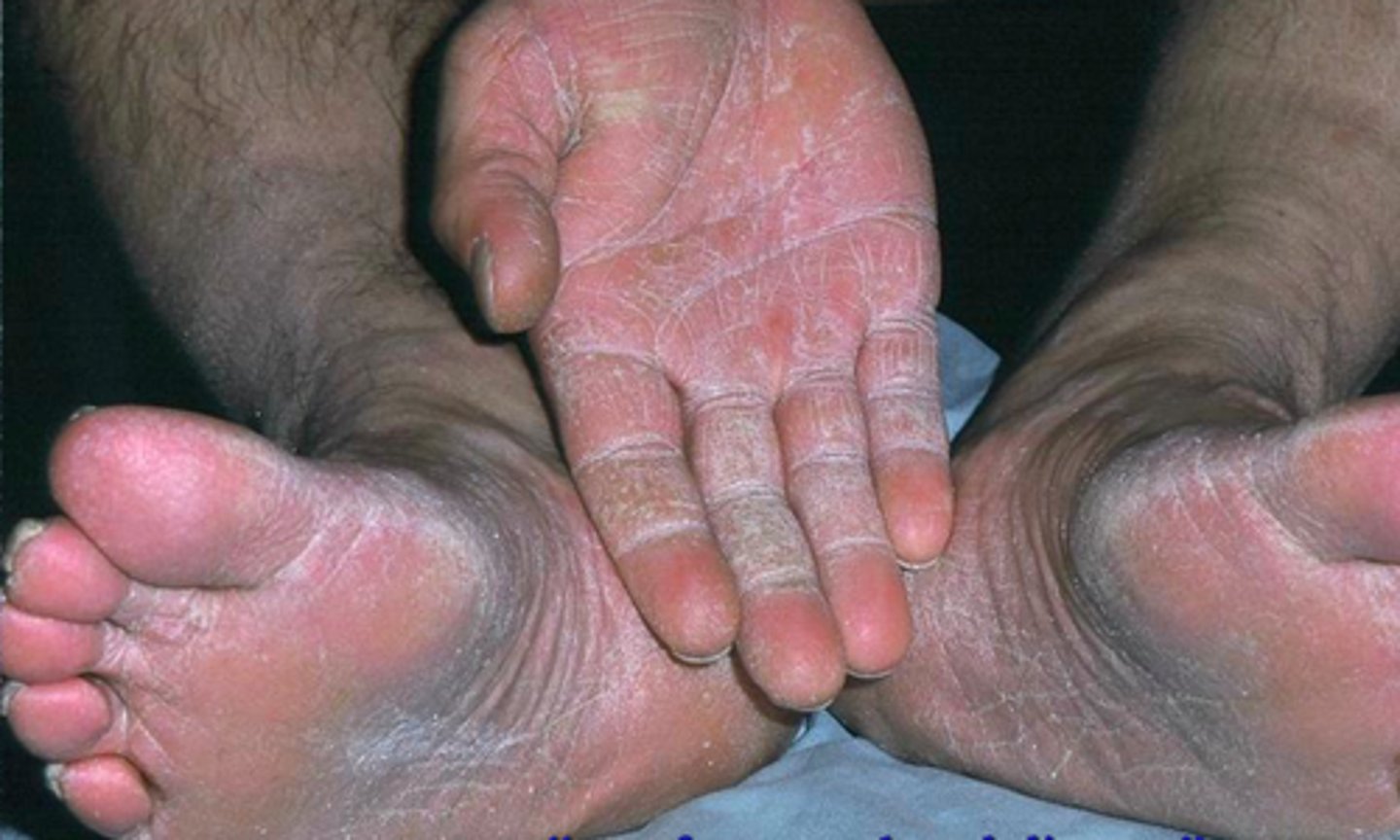 <p>Tinea Manuum</p>
