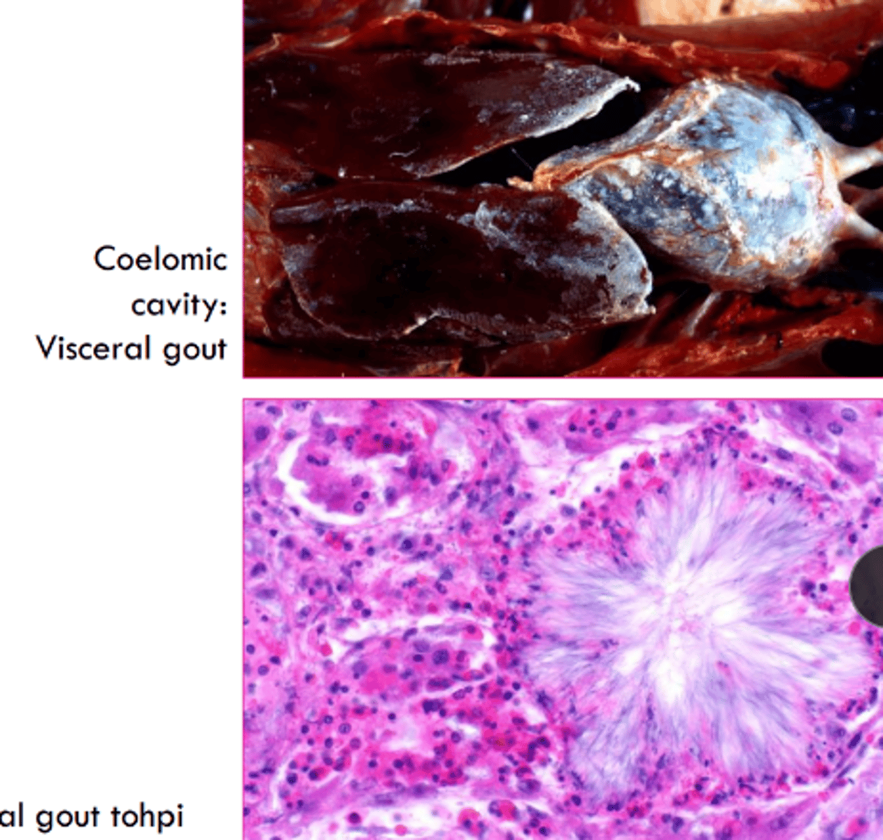 <p>gout</p>