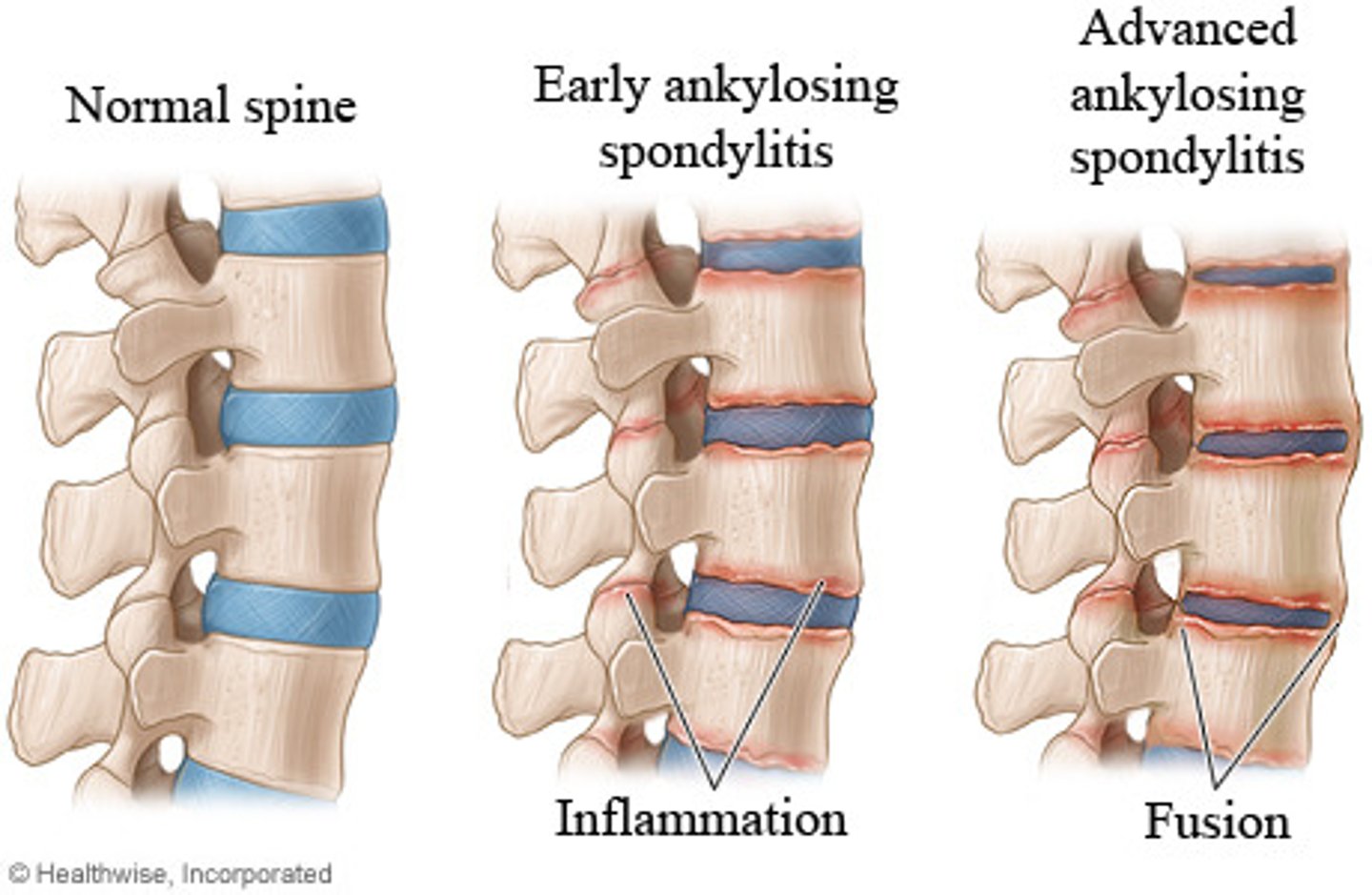 <p>A degenerative disorder that can cause the loss of normal spinal structure and function.</p>
