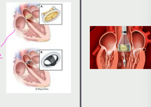 <p>SAVR (surgical aortic</p><p>valve replacement)</p><p>TAVR (transcatheter</p><p>aortic valve</p><p>replacement)</p>