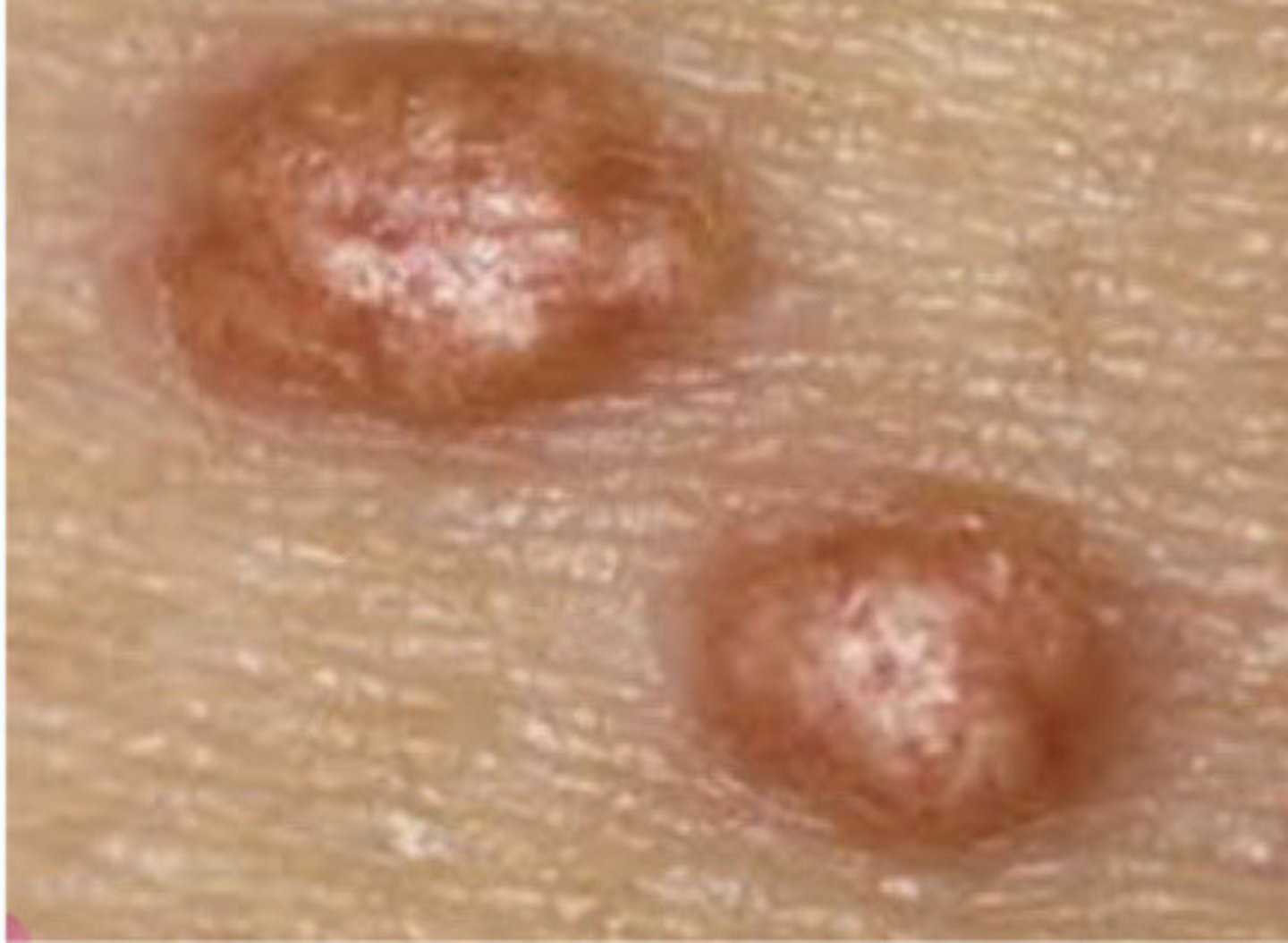 <p>Xanthoma</p>