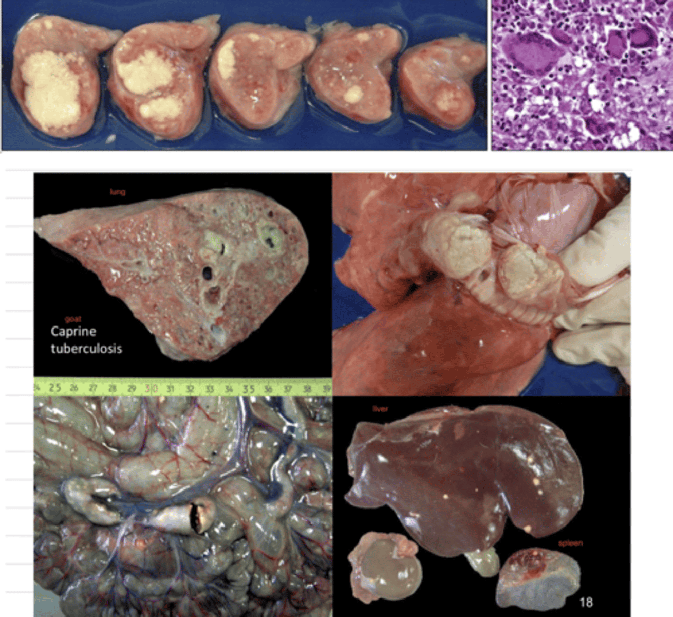 <p>grossly:</p><p>surrounded by an external fibrous capsule</p><p>yellow</p><p>sometimes hard</p><p>microscopically:</p><p>foci of nuclear and cytoplasmic remains</p><p>dead leukocytes</p>