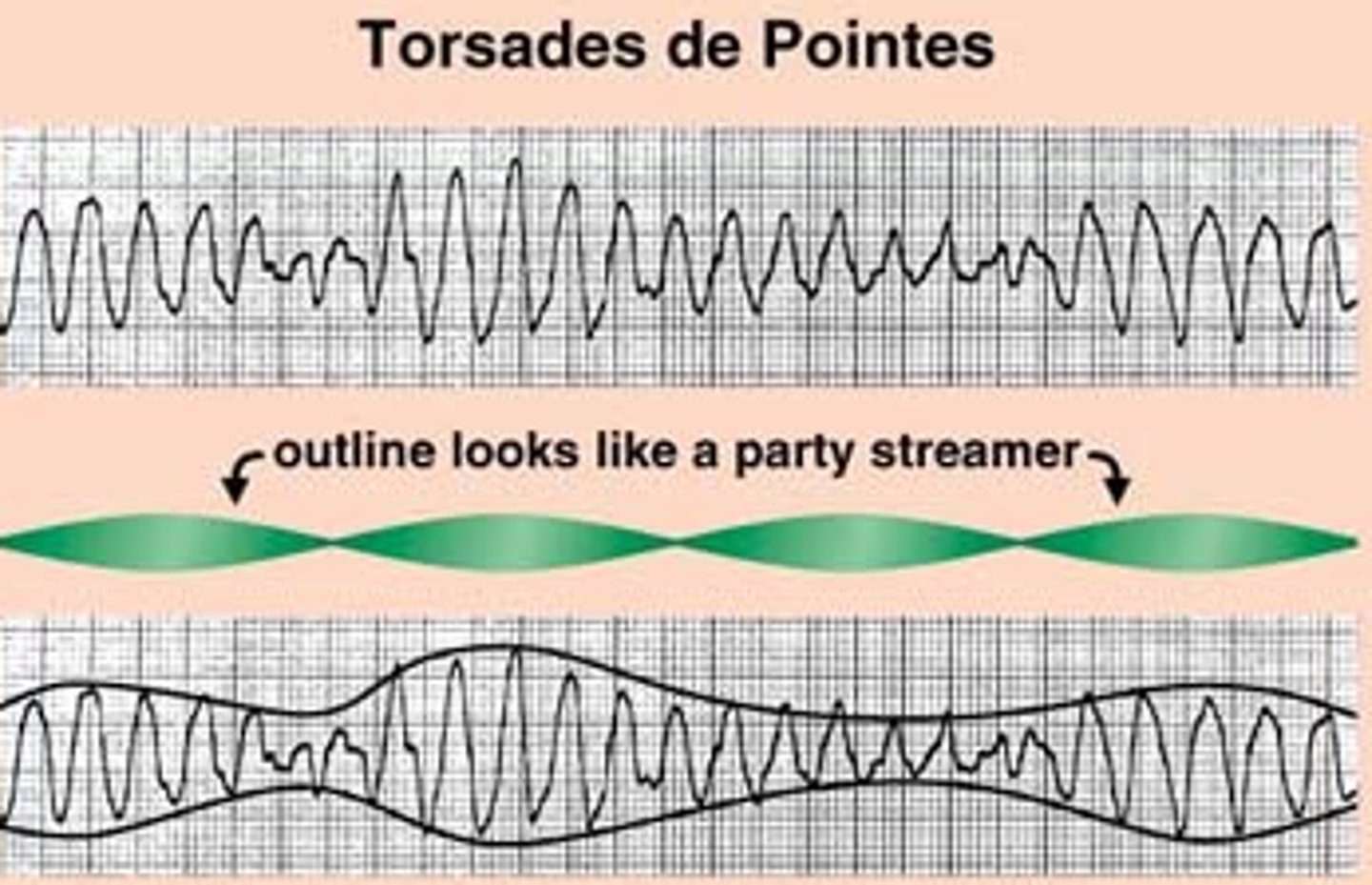 <p>- macrolides</p><p>- fluoroquinolones</p><p>- fluconazole</p><p>- antiarrhythmics (amiodarone)</p><p>- antipsychotics (haloperidol, quetiapine)</p><p>- antidepressants (TCAs, SSRIs)</p><p>- ondansetron</p><p>- drugs causing hypokalemia/ hypomagnesemia</p>