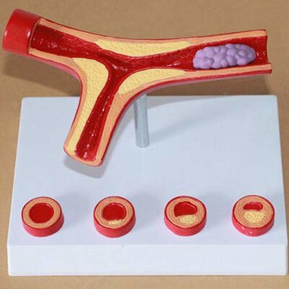 <p>condition where fatty deposits (plaques) build up inside the walls of arteries, thickening and stiffening them over time.</p>