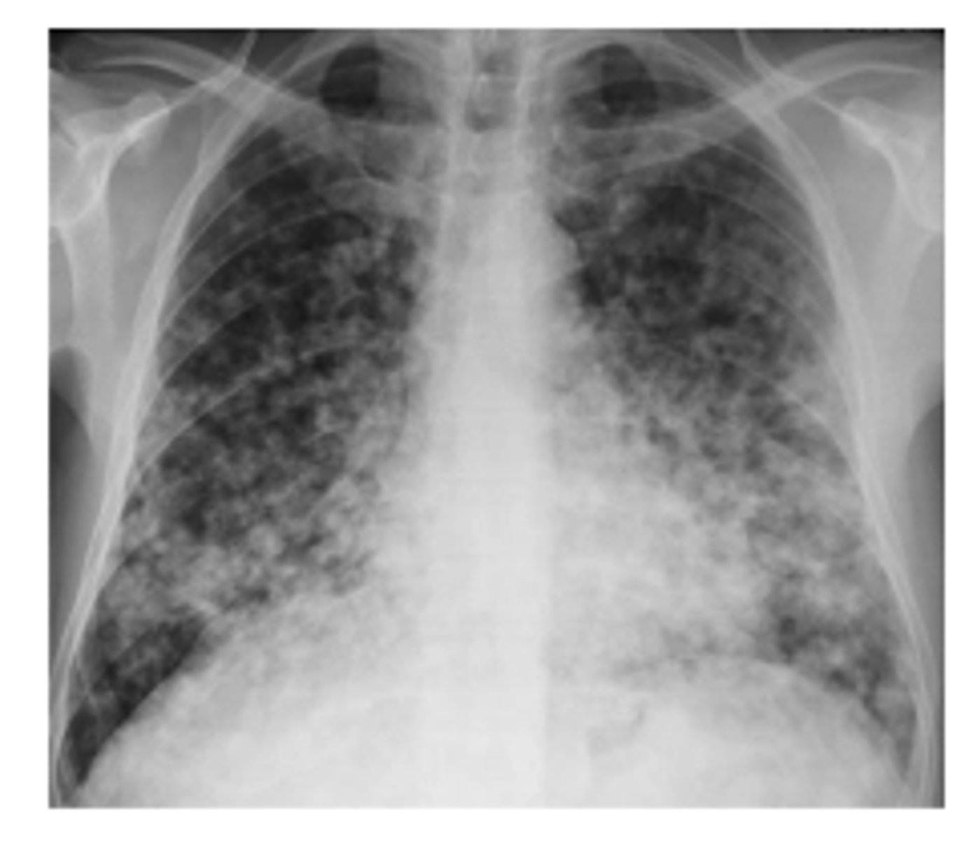 <p>Nodular</p><p>A nodular pattern consists of multiple round opacities, generally ranging in diameter from 1 mm to 1 cm</p>